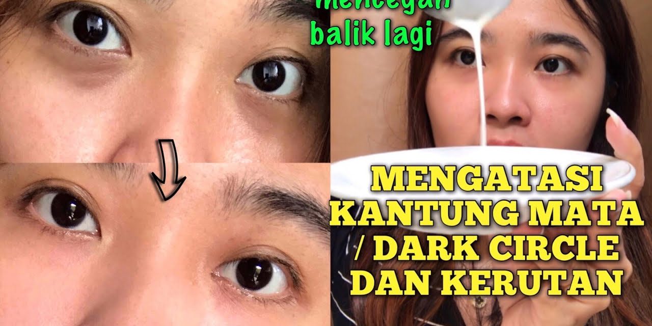 Atasi Kantung Mata Hitam Dengan Perawatan Harian Yang Tepat