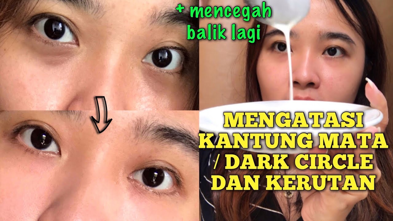 Atasi Kantung Mata Hitam
